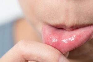 Common Oral Infections