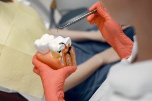 Root canal explanation