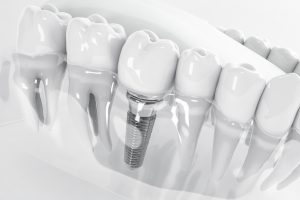 illustration of single dental implant