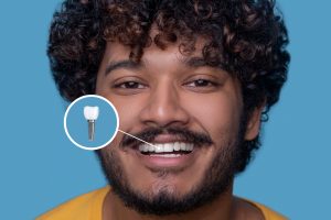 a young man open mouth showing his implanted teeth