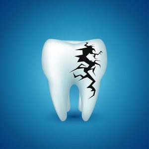 CRACKED TEETH
