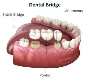 Cosmetic Bridges