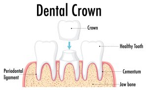 dental crown