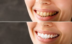 Teeth whitening