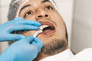 Homepage 11 lost a dental crown ? - Dental Crown treatment